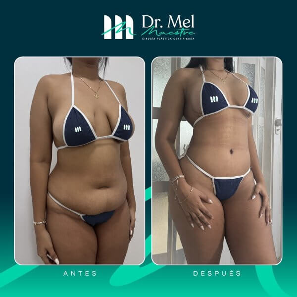 Abdominoplastia