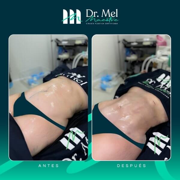 Marcación abdominal