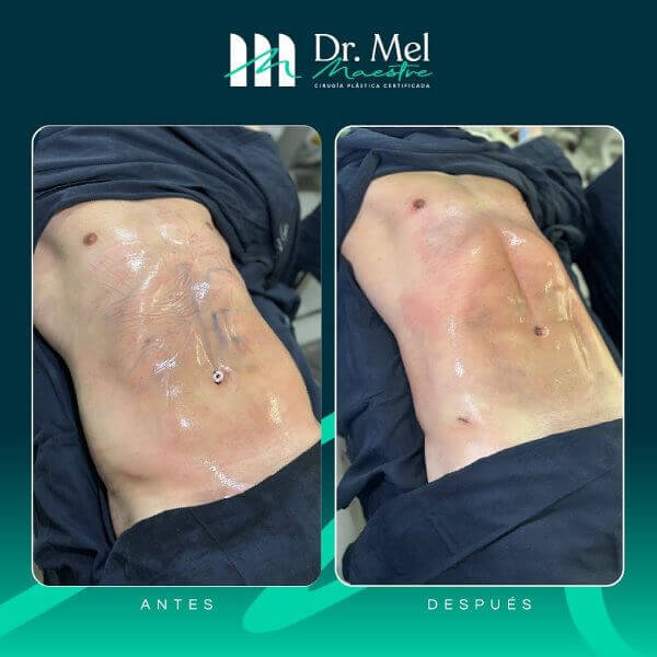 Marcación abdominal en hombres