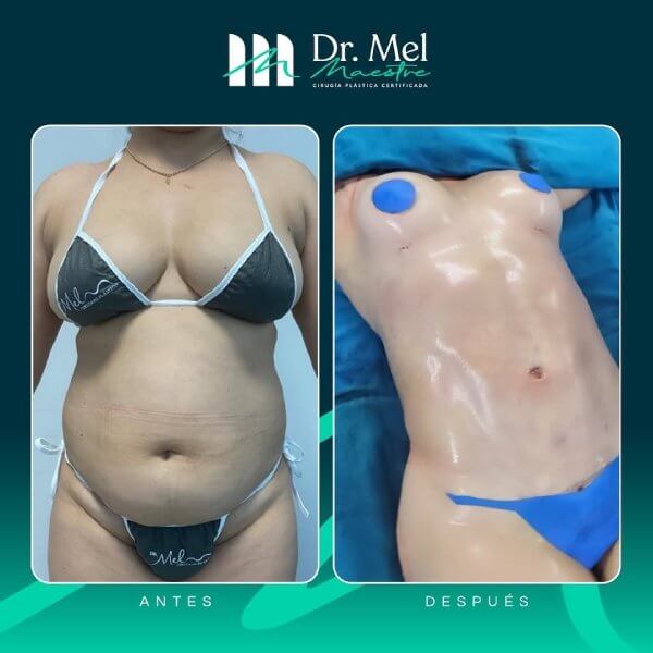 Abdominoplastia