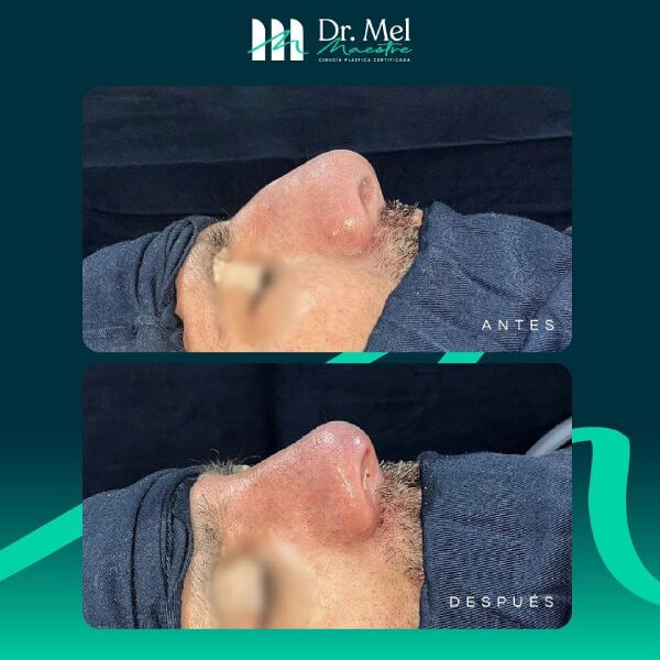 Rinoplastia masculina