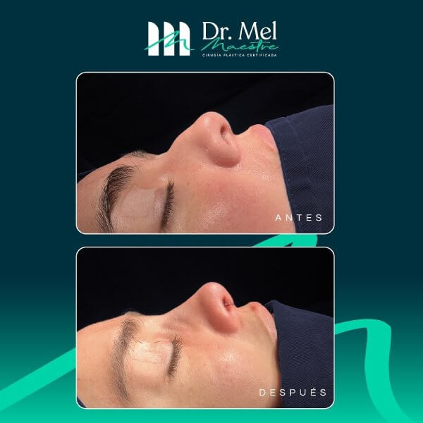 Rinoplastia