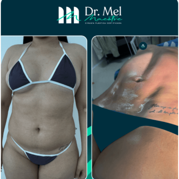 Marcación abdominal