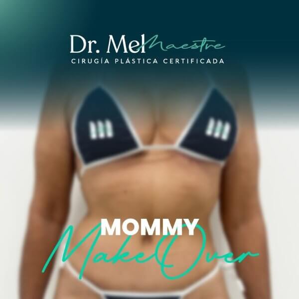 Mommy Makeover