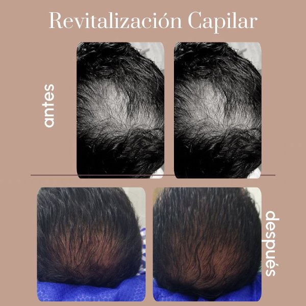 Alopecia