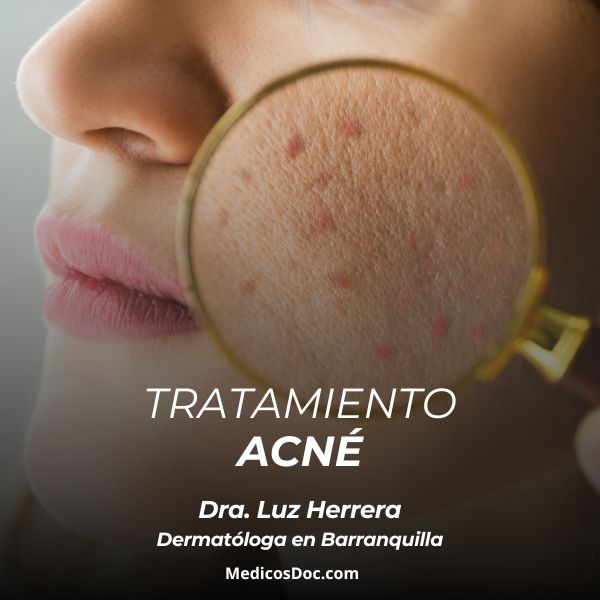 Acne treatment