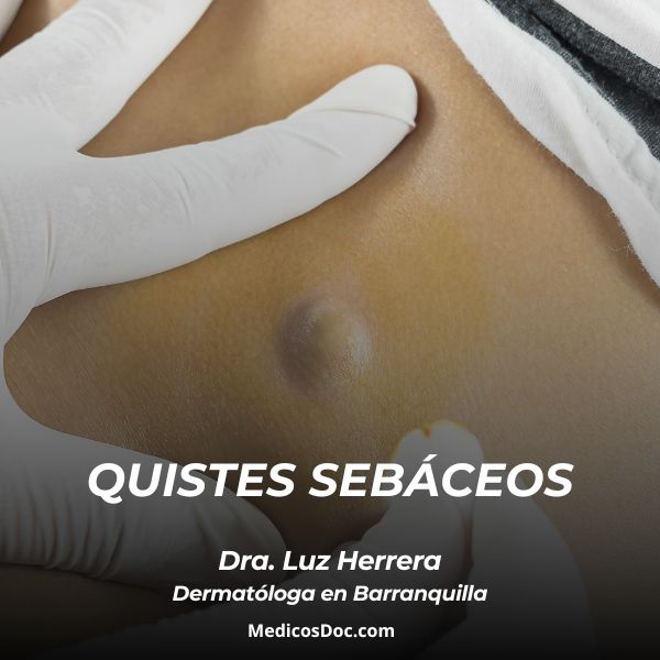 Quistes sebáceos