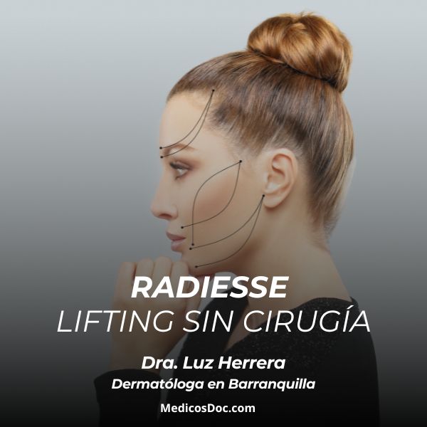 Radiesse lifting sin cirugía