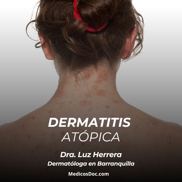Dermatitis atópica