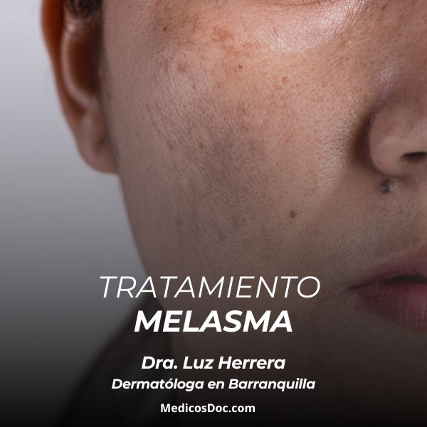 Tratamiento para melasma 