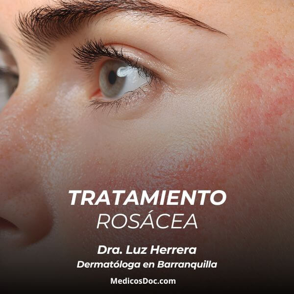Tratamiento para la rosácea