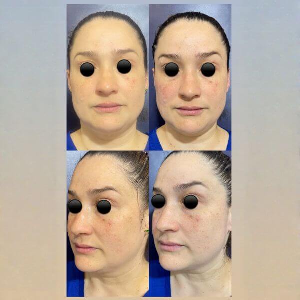 Antes y después Dermazoom - Dra. Laura Habib