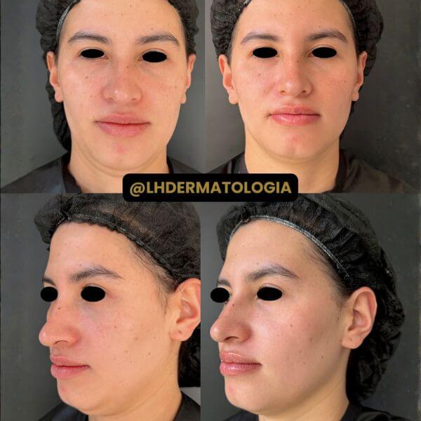 Dermazoom