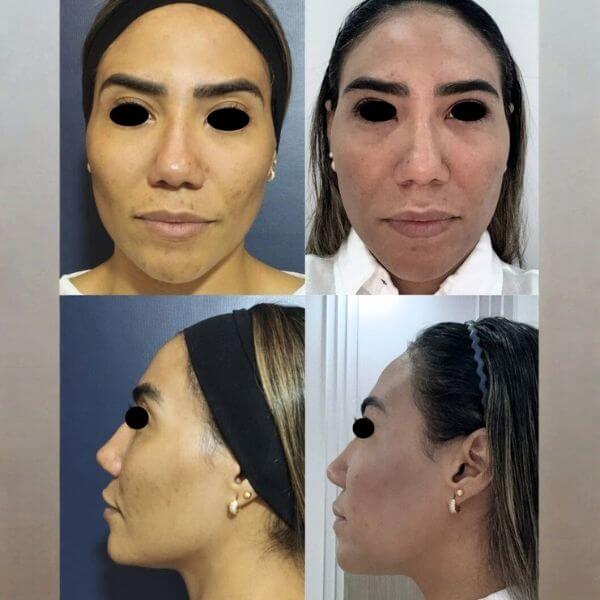 Dermazoom