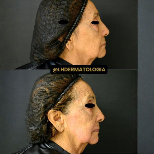 Dermazoom