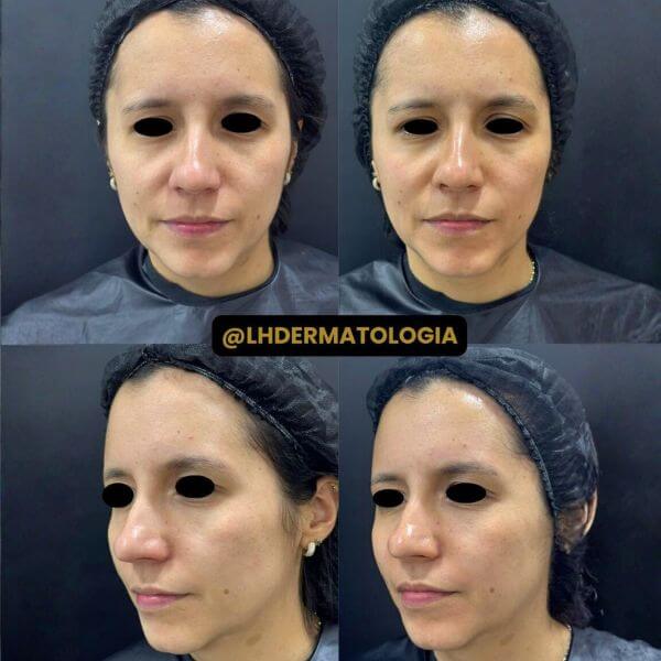 Dermazoom