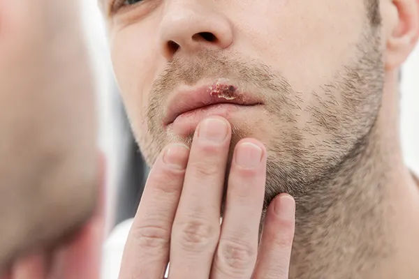 Tips from dermatologist Laura Habib on how to prevent cold sores
