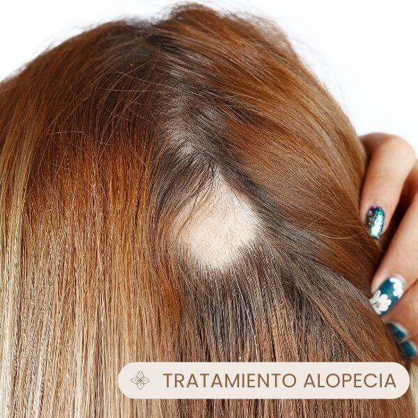 Alopecia areata
