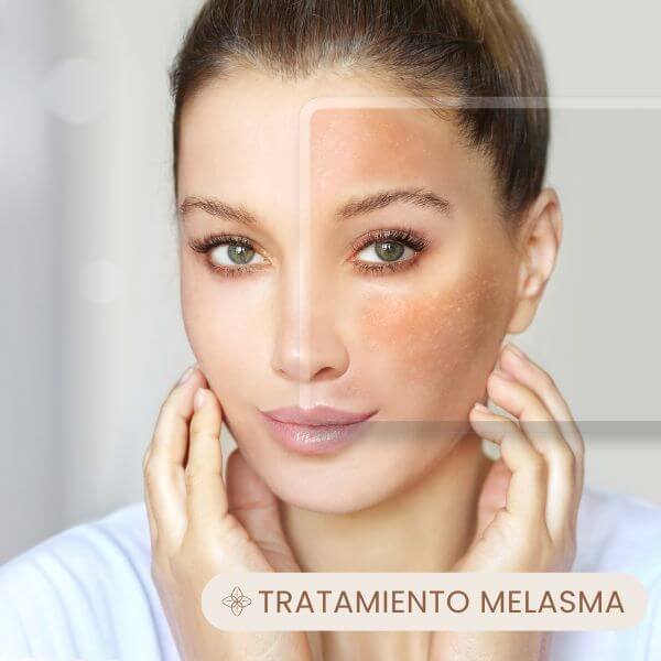 Melasma