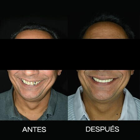 Diseño de sonrisa
