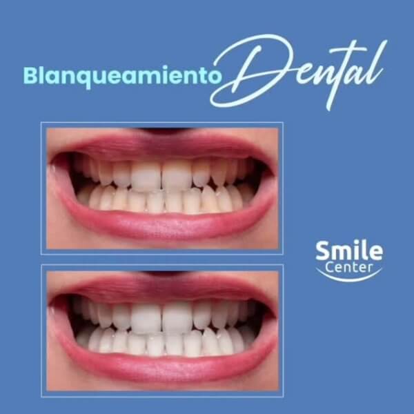 Blanqueamiento dental