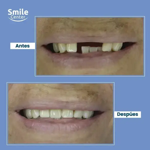 Implantes dentales