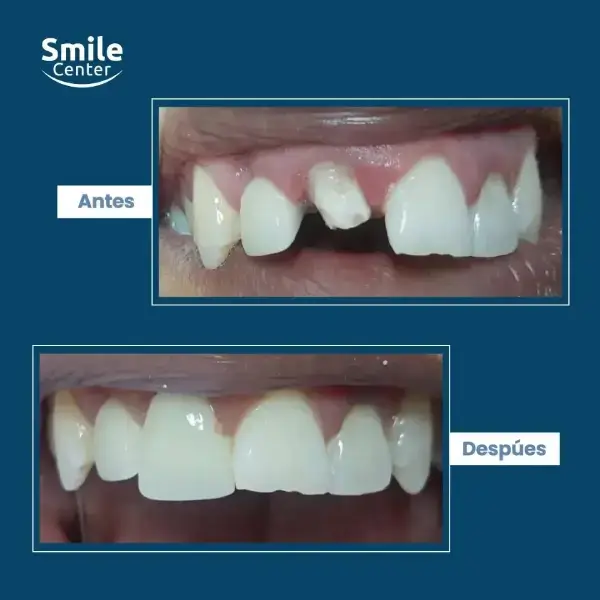 Corona dental