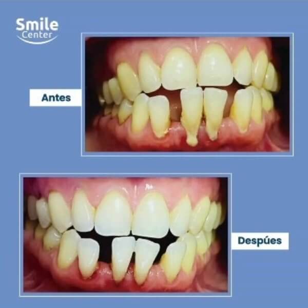 Tratamiento periodontal