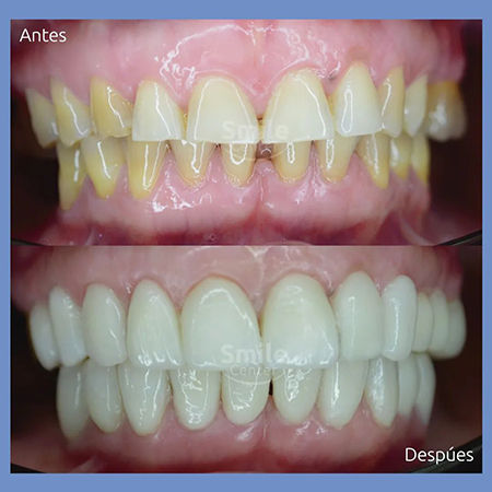 Diseño de sonrisa