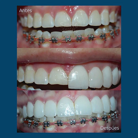 Diseño de sonrisa