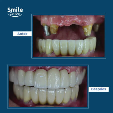 Prótesis dental