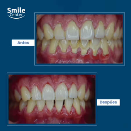 Limpieza dental