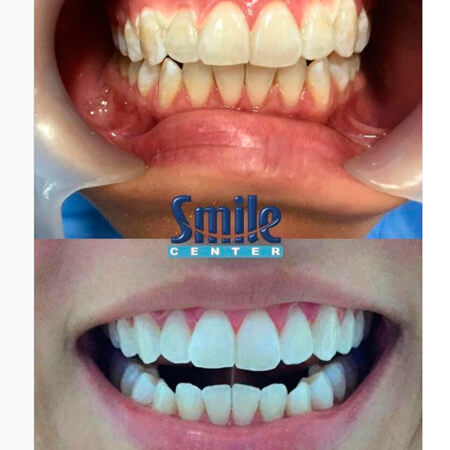 Blanqueamiento dental