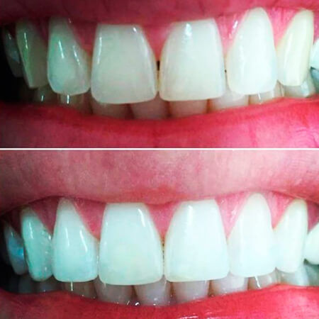 Blanqueamiento dental