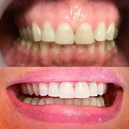 Diseño de sonrisa