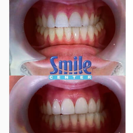 Diseño de sonrisa
