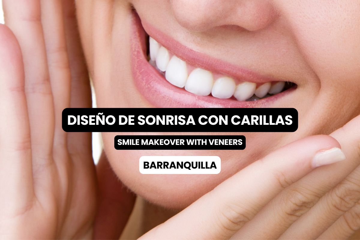 Diseño de sonrisa con carillas en Barranquilla: tipos de carillas, tiempo y cuál elegir