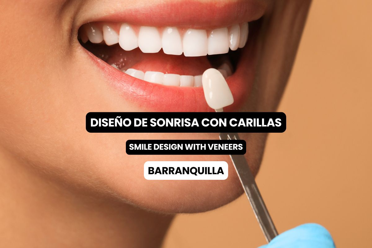 Diseño de Sonrisa con Carillas en Barranquilla: Tipos de Carillas, Tiempo y Cuál Elegir