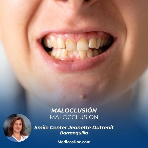  Malocclusion