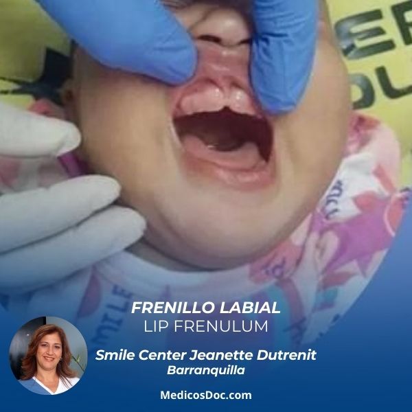Labial frenulum