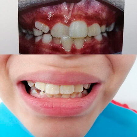 Maxillary orthopedics