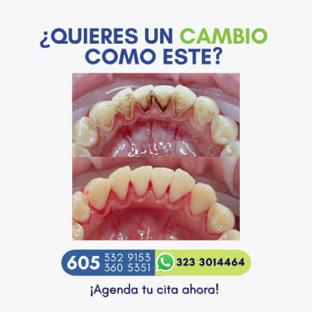 Dental cleaning