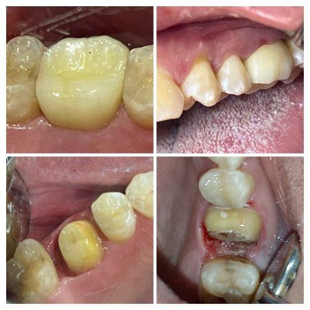Oral rehabilitation