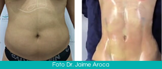 Abdominal etching Colombia