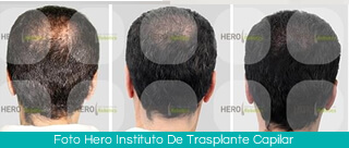 Hair transplant Colombia