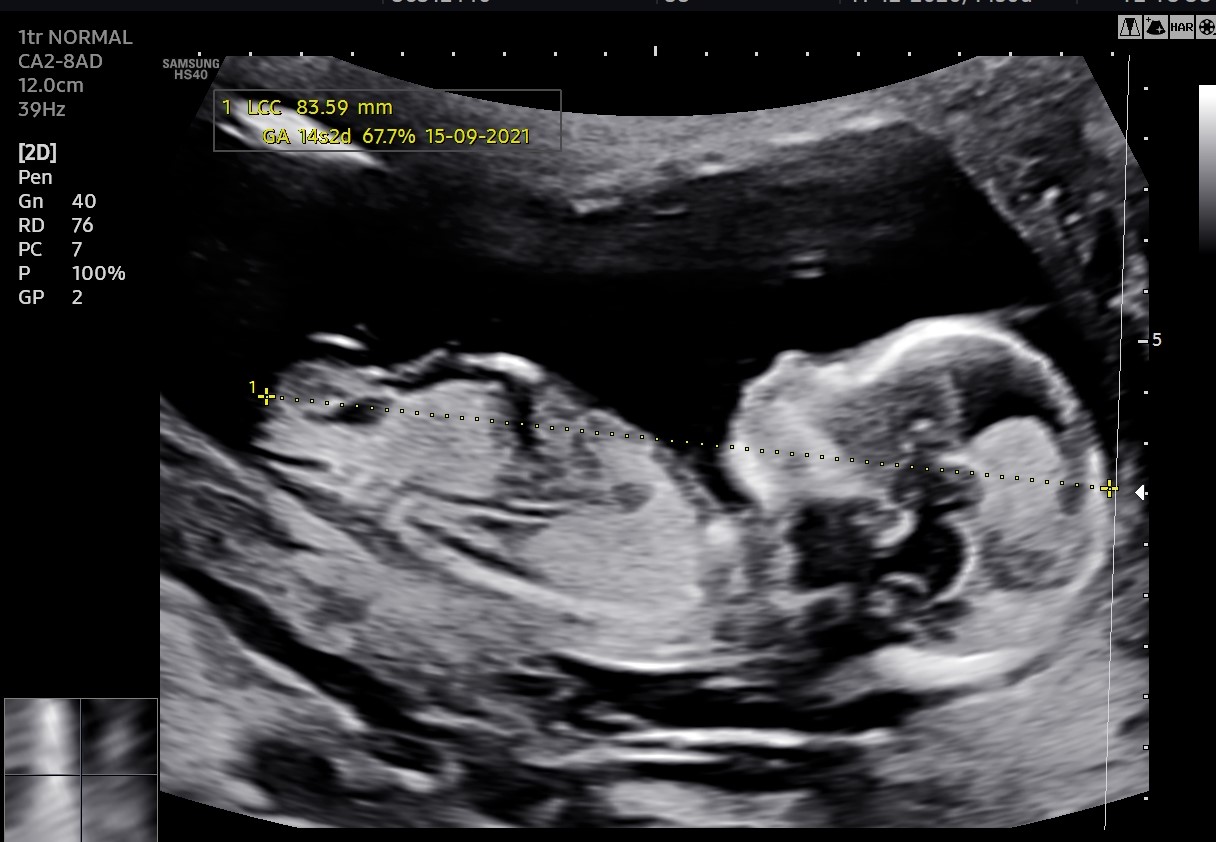The importance of screening ultrasound between weeks 11 and 14 by gynecologist Yolima Martinez
