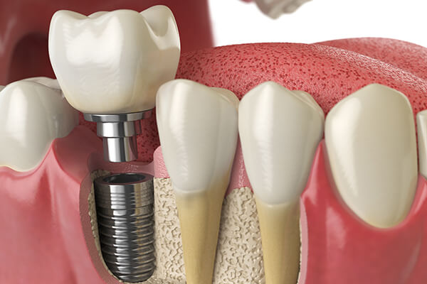 Implantes dentales en Colombia - Turismo dental - Precios 2024
