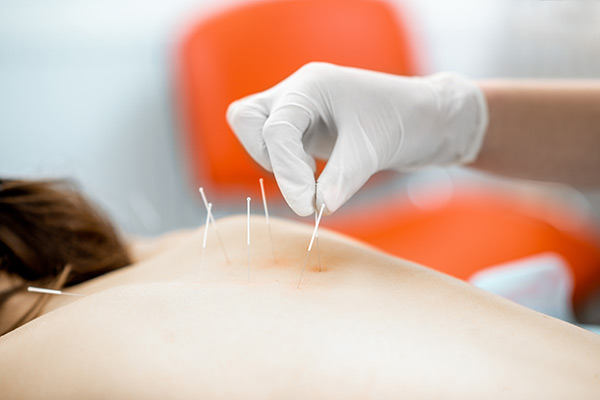 Exploring Acupuncture in Medellin: Answers to Your Frequently Asked Questions