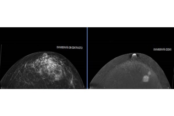 mamografia CESM