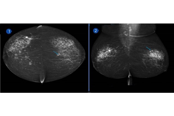 Câncer de mama multifocal/multicêntrico: Perfil clínico